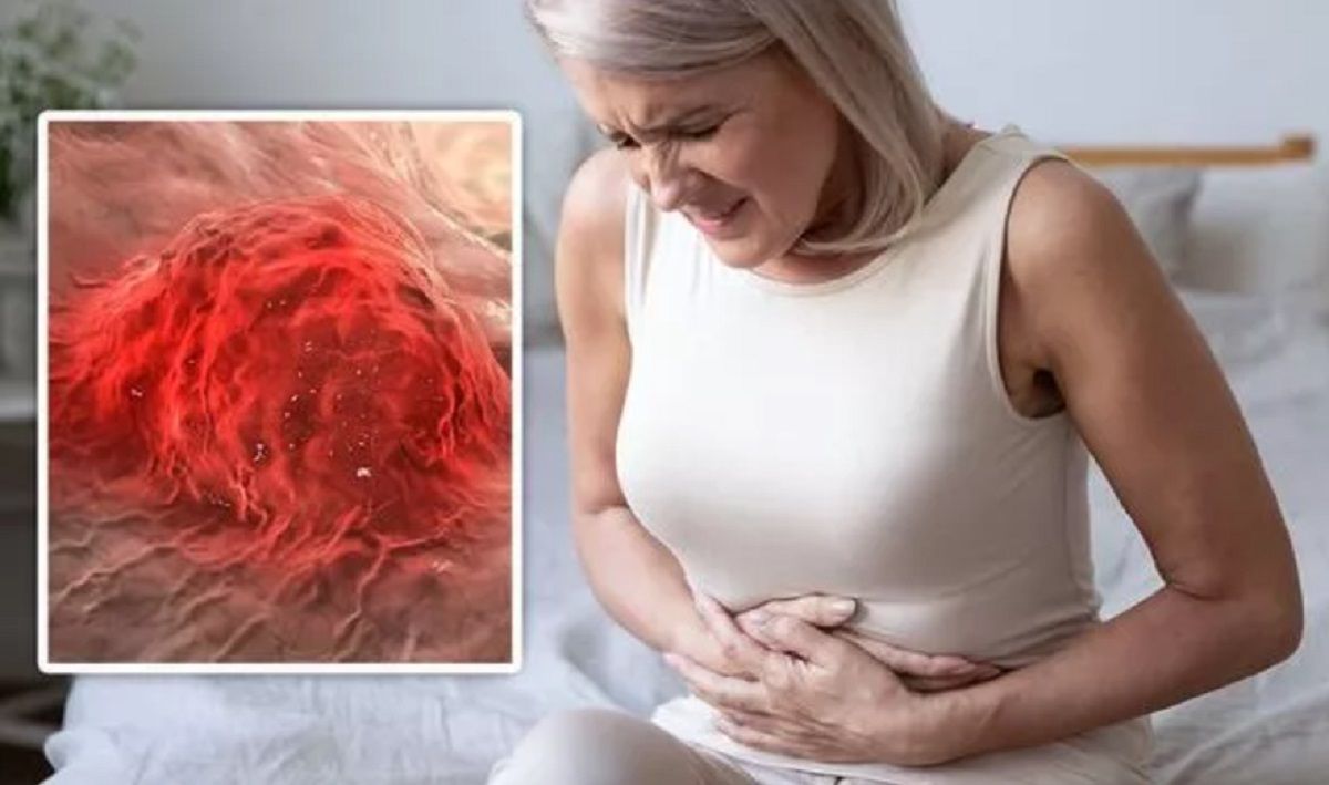 cancer intestinal